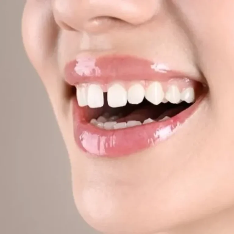 Restoratif Diş Tedavisi Nedir