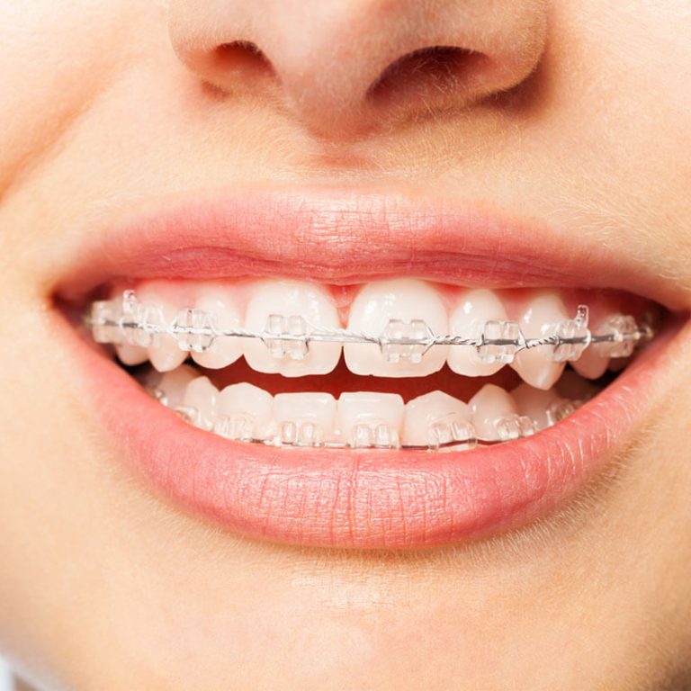 Şeffaf Diş Teli Nedir