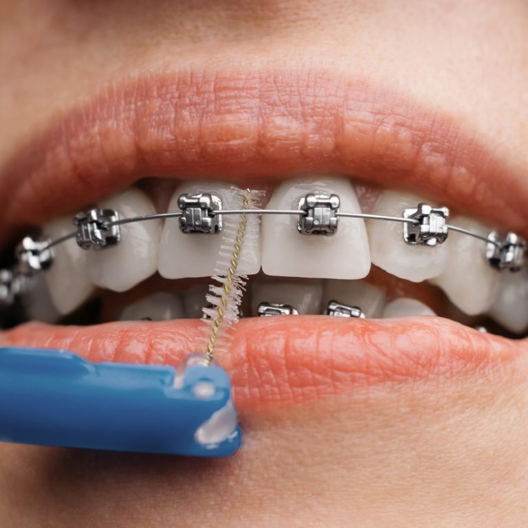 Young woman cleans braces with a dental brush, close-up. Dental hygiene.