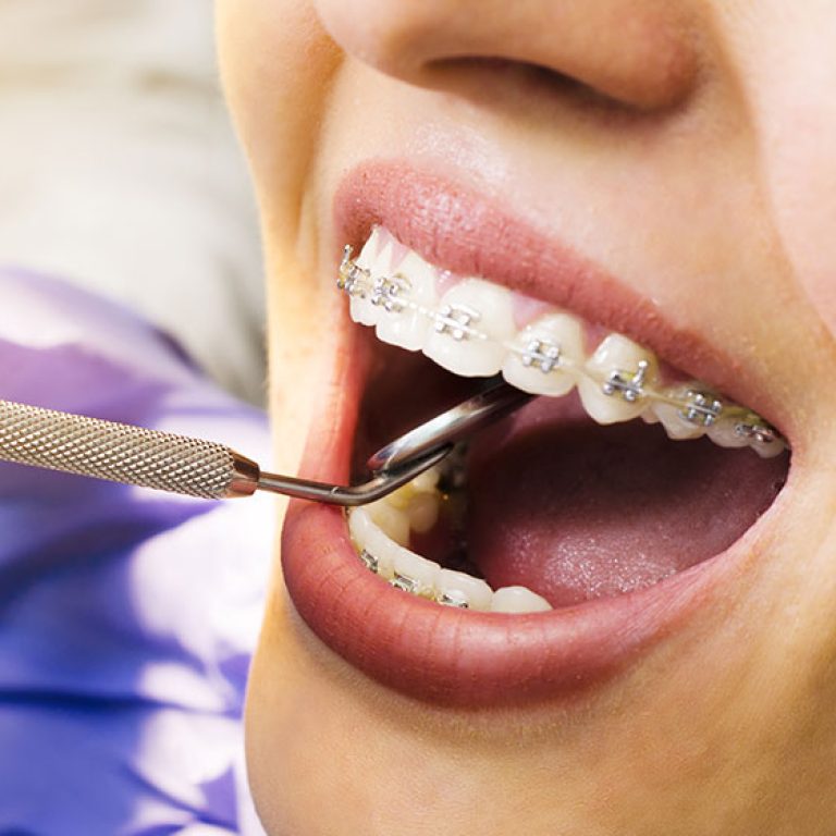 yetiskinlerin-tel-tedavisi-zor-mudur_20180517155317